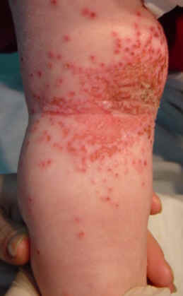 Niño de 13 meses con dermatitis atópica extensa, que consultó por presentar exacerbación de las lesiones localizadas en hueco poplíteo de 2 dias de evolución que se habían diseminado apareciendo lesiones nuevas en pierna, tronco y extremidades superiores. el examen clínico reveló la presencia de una lesion ulcerada, superficial, exudatia, rodeada de múltiples vesículas umbilidadas, todas ellas en el mismo estadio de evolución.