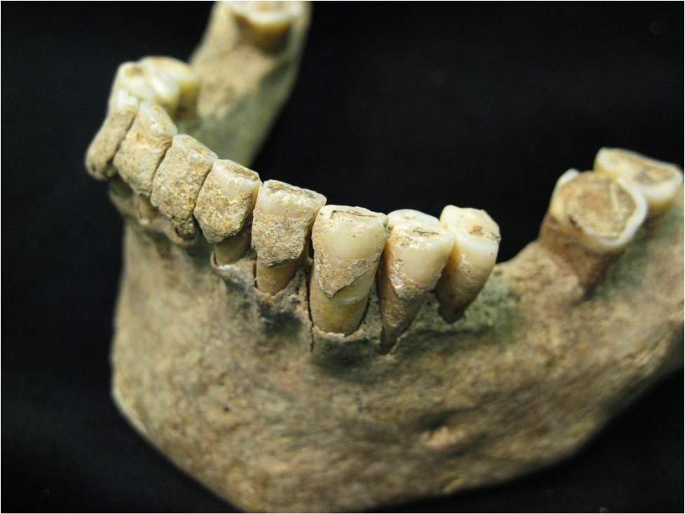 Placa dental mineralitzada en la dentadura d’un home de mitjana edat del jaciment medieval de Dalheim, del 1100 DC. Foto: Christina Warinner.