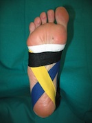 Video Fascitis Plantar
