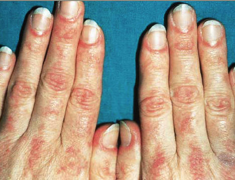 Dermatomiositis. Eritema en dorso de articulaciones (signo de Gottron)Provost TT, Flyn JA. Dermatomyositis. in Cutaneous medicine. BC. Deckered 2001.
