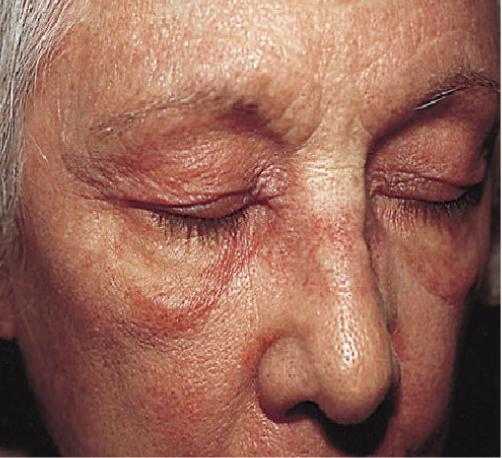 Marzia Caproniy col Amyopathic Dermatomyositis. A Review by the Italian Group of Immunodermatology Arch Dermatol. 2002;138:23-27