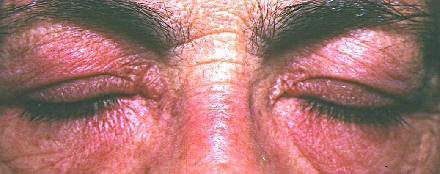 Maculas eritematosas, eczematosas de distribucin simtrica en ambos parpados en una paciente con dermatomiositis