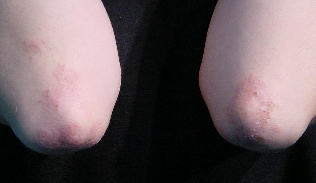 Dermatitis herpetiforme: paciente de 23 aos con historia de prurito intenso de varios meses de evolucion asociadas al desarrollo de lesiones cutneas en forma de papulas y vesiculas de distribucin simtica afectando a codos y rodillas