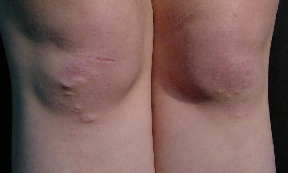 Dermatitis herpetiforme: paciente de 23 aos con historia de prurito intenso de varios meses de evolucion asociadas al desarrollo de lesiones cutneas en forma de papulas y vesiculas de distribucin simtica afectando a codos y rodillas