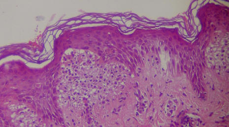 dermatitis herpetiforme. El estudio histolgico muestra la presencia de una apolla subepidermica con numerosos polimorfonucleares de dermis papilar.