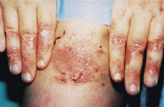 Contact Dermatitis: Causes, Symptoms, Treatments
