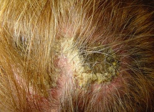 lesiones costrosas en cuero cabelludo