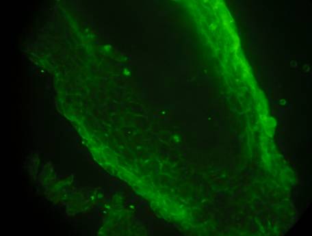Inmunofluorescencia directa de la vaina externa del pelo con positividad con Anti IgG siguiendo un patrn intercelular, observandose especialmente en la region basal de la vaina.