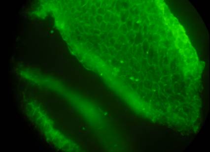 Inmunofluorescencia directa de la vaina externa del pelo con positividad con Anti IgG siguiendo un patrn intercelular