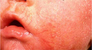 dermatitis eczema #11