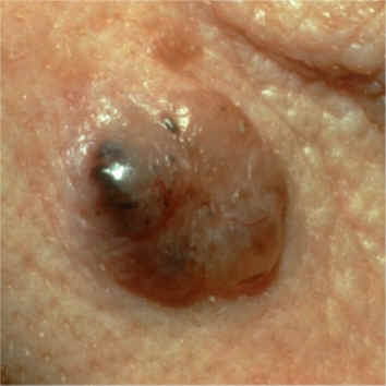 Carcinoma basocelular pigmentado (AAD)