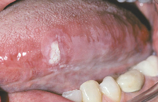 Leucoplasia difusa de la cara lateral de la lengua. La biopsia de la zona ms engrosada mostr un carcinoma epidermoide invasivo incipiente