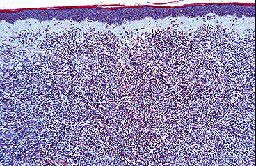 Patron arquitectural difuson con una zona de dermis papilar respetada (Zona de Grenz) caracterstico de los linfomas B