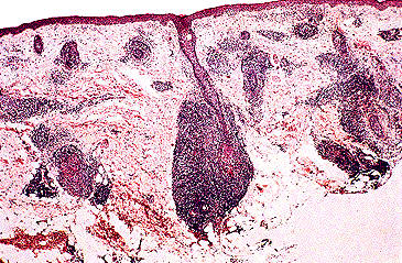 Patron perivascular y perianexial, que puede verse en las fases iniciales de los linfomas B y T no micosis fungoide