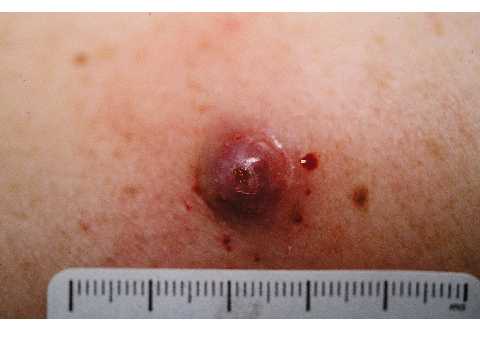 Nodular melanoma symptoms | Library | SkinVision