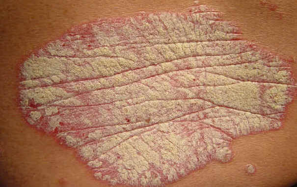 Imagenes de la clase de psoriasis