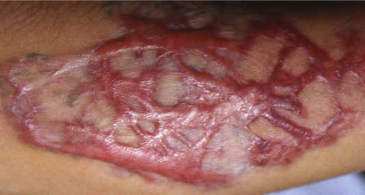 Queloide desarrollado tras el tratamiento con laser de alejandrita de un tatuaje