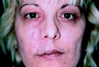 misma paciente tras tratamiento con laser de colorante pulsado y cirugia. Troilius, Agneta. Dermatologic Therapy 2000, 13 (1), 17-23.