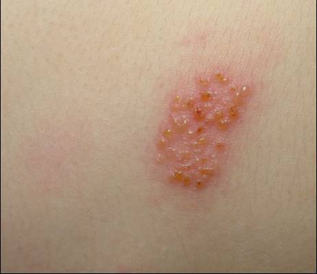 Shingles (Herpes Zoster Virus) Pictures ... - OnHealth