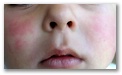Eritema intenso en ambas mejilas sin afectación del dorso de nariz