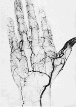 Angiograma del paciente mostrando la oclusin de varias arterias digitales. The New England Journal of Medicine -- September 3, 1998 -- Vol. 339, No. 10