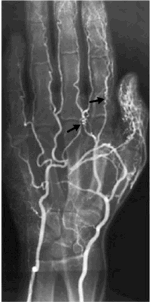 La arteriografia muestra la oclusion de varias de las arterias digitales asi como la formacion de vasos colaterales con la imagen en sacacorchos.The New England Journal of Medicine -- November 2, 2000 -- Vol. 343, No. 18