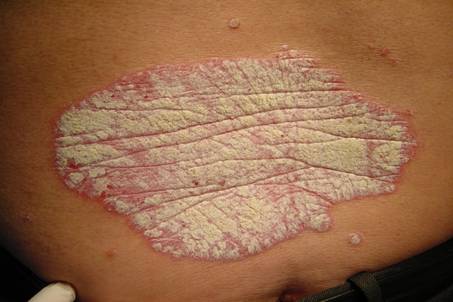 Homemade remedies for Psoriasis