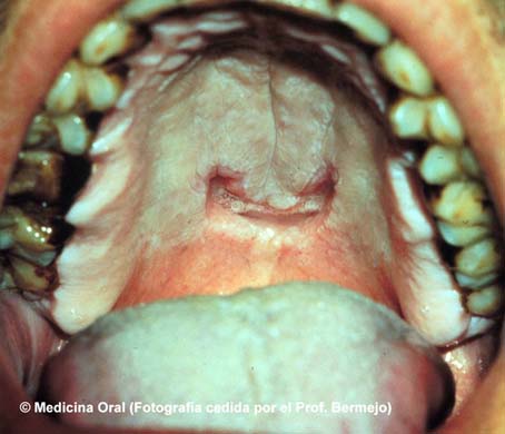 http://www.uv.es/medicina-oral/Docencia/atlas/2/40.jpg