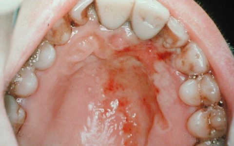 oral herpes