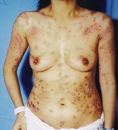 Ghohtestani RF. Color atlas:autoimmune blistering skin diseases. Clin Dermatolo 2001;19:642