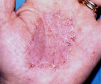 La psoriasis vulgar sobre las uñas