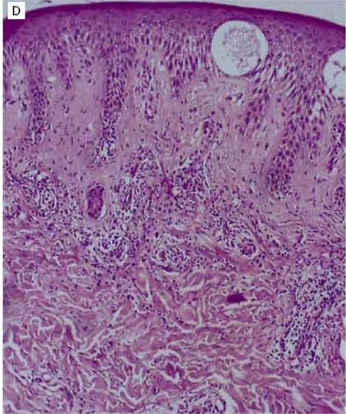 Imagen histologica de la dermatitis de contacto alrgica (NEJM)