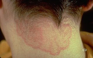 Dermatophyte (tinea) infections - UpToDate