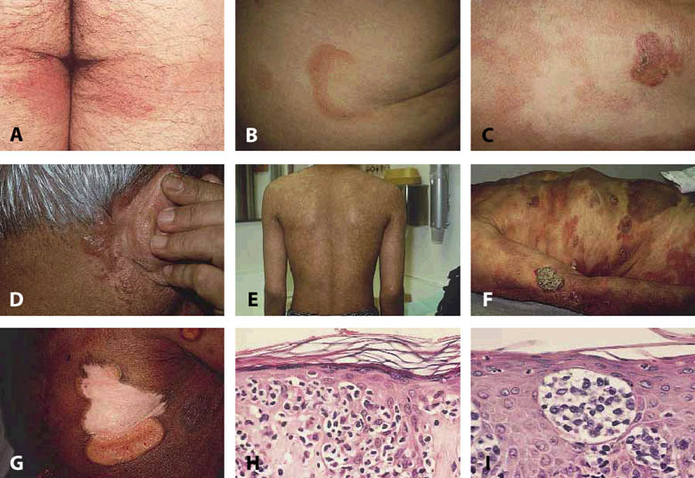 Micosis fungoide. A-C: mculas y placas de MF. D: mucinosis folicular en paciente con MF. E: variante hipopigmentada de la enfermedad en mculas generalizaada. F: tumores de MF apareciendo en asociacin  con mculas y placas. G: placas ulceradas. H: epidermotropismo caracterstico en mculas, placas y eritrodermia. I: microabscesos de pautrier. JAAD 2002, 46:325-357.