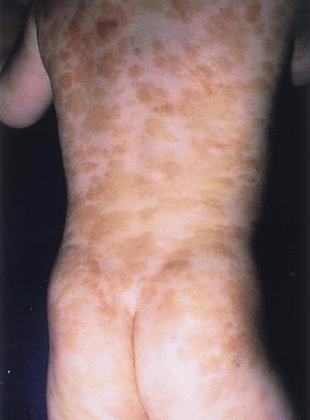 mastocitosis cutnea maculo papular. mltoples placas amarillentas bien definidas en el tronco.