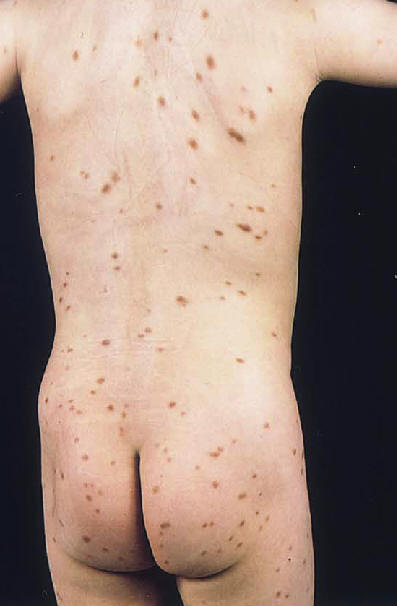 Urticaria pigmentosa o mastocitosia maculo-papular infantil.