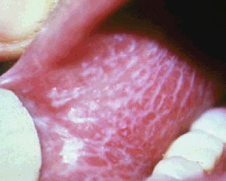 Patron reticulado de la mucosa oral en el liquen plano