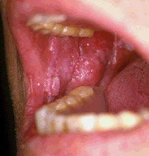 Liquen plano de la mucosa oral con áreas blanquecinas reticuladas y áreas erosivas
