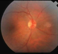 Examen del fondo del ojo derecho.