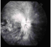 Angiografia con fluoresceina del ojo derecho