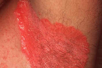 Psoriasis invertido. La afectacin de los pliegues como el axilar, se caracteriza por placas eritematosas, bien delimitadas, exudativas y cubiertas de pocas escamas.