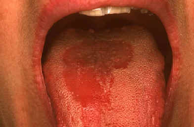 Psoriasis de la lengua. Placa eritematosa bien delimitada. Lachapelle JM: Atlas of Dermatology. UCB pharmaceuticals