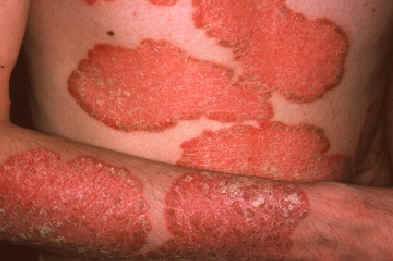 Psoriasis en placas. Placas eritematosas bien delimitadas en tronco. Lachapelle JM: Atlas of Dermatology. UCB pharmaceuticals