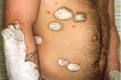 Psoriasis en placas con marcada hiperqueratosis. Lachapelle JM: Atlas of Dermatology. UCB pharmaceuticals