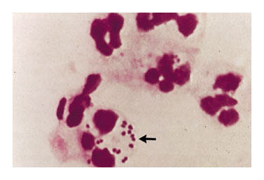 Neisseria meningitidis (flecha) en liquido cefalo raquideo (Tincin de Gram x 1000). NEJM 2001 -- Vol. 344, No. 18  