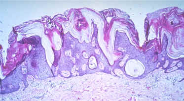 imagen histolgica de una queratosis seborreica con acantosis, papilomatosis, hiperqueratosis y formacin de pseudoquistes crneos