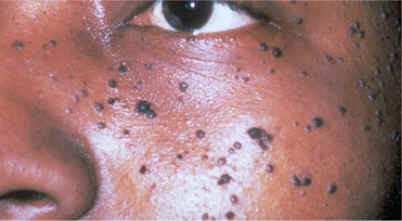 Multiples queratosis seborreicas (dermatotis papulosa nigra)