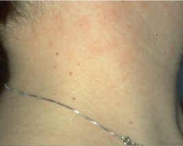 imagen de acrocordones en cara lateral de cuello (AAD)