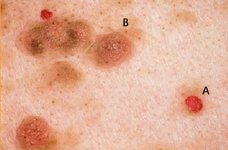 Los hemangiomas rubi suelen observarse en el torax como peques papulas eritemtosas (A) que con frecuencia coexisten con mltiples queratosis seborreicas (B). Lachapelle JM. Atlas de Dermatologa. UCB pharmaceuticals