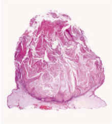 Imagen histolgica del queratoacantoma. Lesion endoexoftica con un crater queratsico central. NEJM.